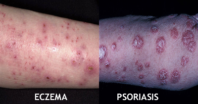 eczema-vs-psoriasis