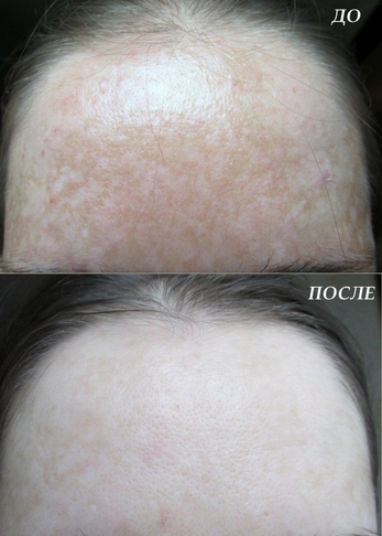 Serum Collagen Teana C1 chong lao hoa, cai thien sac to da ,giup da sang hong rang ro