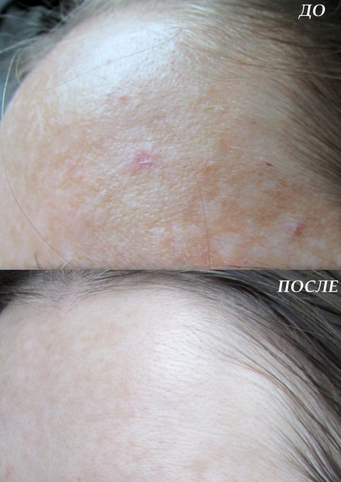 Serum Collagen Teana C1 chong lao hoa, cai thien sac to da ,giup da sang hong rang ro